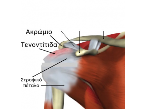 Τενοντίτιδες